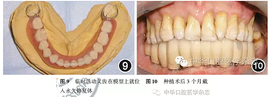 【專家筆談】即刻種植治療方案的評估與實施