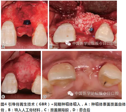 手把手教你做種植軟組織成形