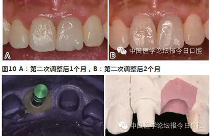 手把手教你做種植軟組織成形