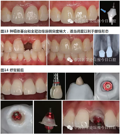 手把手教你做種植軟組織成形