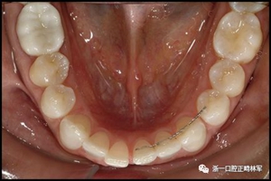 正畸文獻(xiàn)閱讀--固定舌側(cè)保持器作用下意外的牙齒移動
