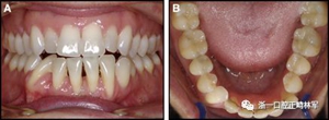 正畸文獻(xiàn)閱讀--固定舌側(cè)保持器作用下意外的牙齒移動
