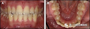 正畸文獻(xiàn)閱讀--固定舌側(cè)保持器作用下意外的牙齒移動