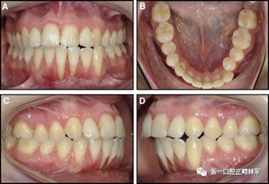 正畸文獻(xiàn)閱讀--固定舌側(cè)保持器作用下意外的牙齒移動