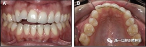 正畸文獻(xiàn)閱讀--固定舌側(cè)保持器作用下意外的牙齒移動