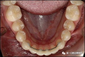 正畸文獻(xiàn)閱讀--固定舌側(cè)保持器作用下意外的牙齒移動