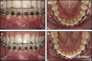 正畸文獻(xiàn)閱讀--固定舌側(cè)保持器作用下意外的牙齒移動