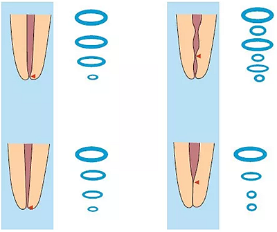 知識分享：規(guī)范化根管治療的細節(jié)分析