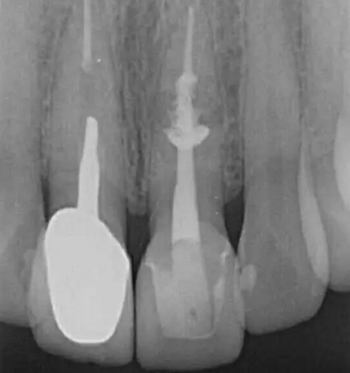 伴隨根管內(nèi)鈣化物形成牙根內(nèi)吸收治療1例