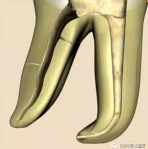 知識分享：根管治療的標(biāo)準(zhǔn)步驟