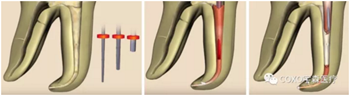 知識分享：根管治療的標(biāo)準(zhǔn)步驟