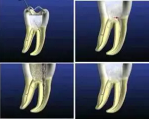 知識分享：根管治療的標(biāo)準(zhǔn)步驟