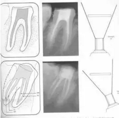 知識分享：根管治療的標(biāo)準(zhǔn)步驟