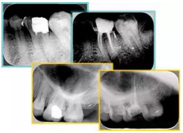 知識分享：根管治療的標(biāo)準(zhǔn)步驟