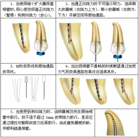 知識分享：根管治療的標(biāo)準(zhǔn)步驟