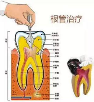 醫(yī)生，牙齒折斷不是應(yīng)該補(bǔ)上去嗎，為啥要做根管治療？