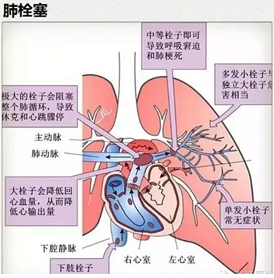 牙醫(yī)要注意！3％雙氧水口腔內(nèi)沖洗致氣體栓塞