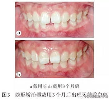 專題筆談 | 無(wú)托槽隱形矯治技術(shù)