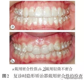 專題筆談 | 無(wú)托槽隱形矯治技術(shù)