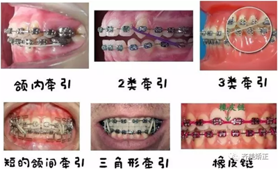 牙齒矯正，為什么要掛橡皮筋？