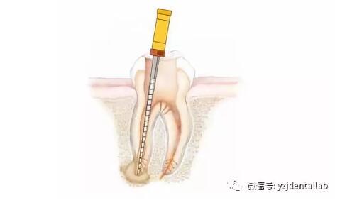 根管治療