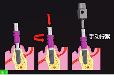 種植體的取模流程