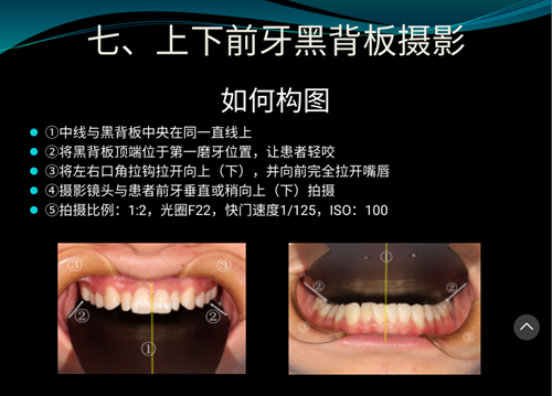 口內(nèi)照攝影方法與技巧分享