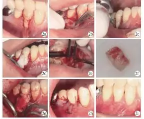 側向轉位瓣結合上皮下結締組織移植治療重度MillerⅢ°牙齦退縮1例