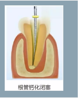 多頻技術(shù)的根管長度測定儀