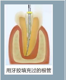 多頻技術(shù)的根管長度測定儀