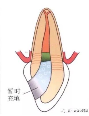 上前牙根管再治療后內(nèi)漂白1例