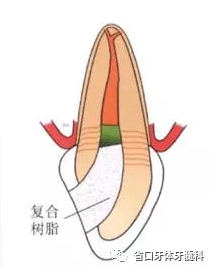 上前牙根管再治療后內(nèi)漂白1例