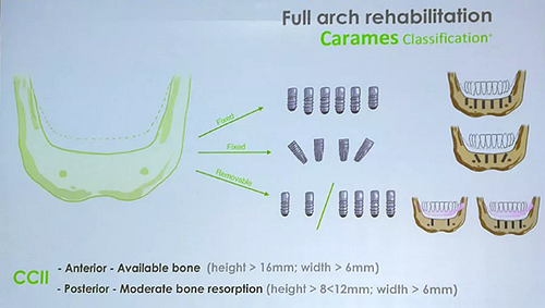 【熱點回顧】帶您深度了解無牙頜種植修復(fù)——Pro Arch