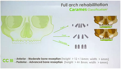 【熱點回顧】帶您深度了解無牙頜種植修復(fù)——Pro Arch