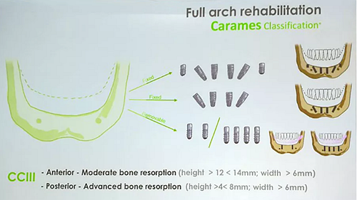 【熱點回顧】帶您深度了解無牙頜種植修復(fù)——Pro Arch