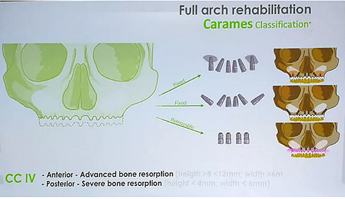 【熱點回顧】帶您深度了解無牙頜種植修復(fù)——Pro Arch