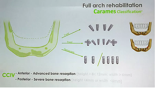 【熱點回顧】帶您深度了解無牙頜種植修復(fù)——Pro Arch