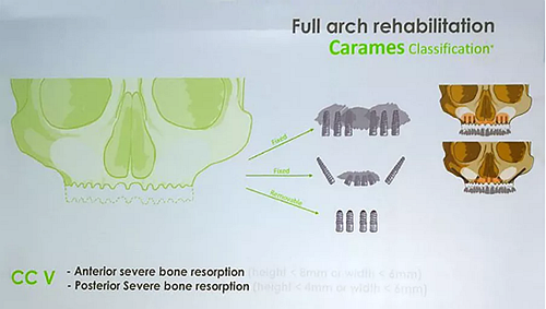 【熱點回顧】帶您深度了解無牙頜種植修復(fù)——Pro Arch