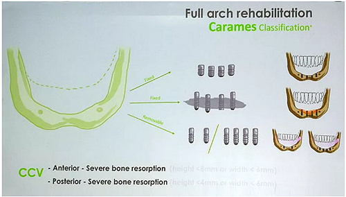 【熱點回顧】帶您深度了解無牙頜種植修復(fù)——Pro Arch