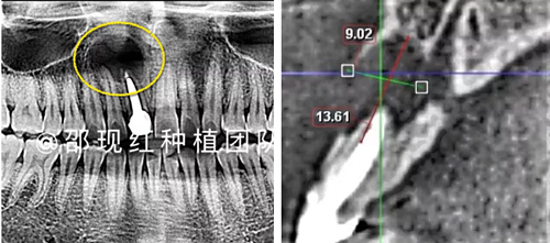 「科普篇」你真的了解它嗎？——β-磷酸三鈣