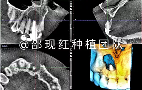 「科普篇」你真的了解它嗎？——β-磷酸三鈣