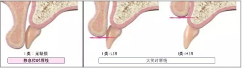 【文獻精讀】唇-齒-牙槽嵴分類：無牙頜上頜牙弓指南。診斷，風險評估及種植治療指征