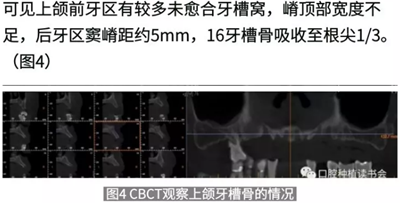 病例報道│全程數(shù)字化輔助無牙頜種植即刻負(fù)重