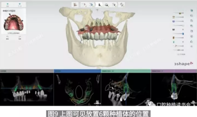 病例報道│全程數(shù)字化輔助無牙頜種植即刻負(fù)重