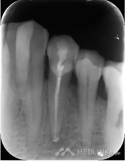 楔狀缺損導(dǎo)致根尖周炎