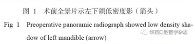 下頜骨腓骨移植聯(lián)合牙種植術(shù)后的覆蓋義齒修復(fù)1例