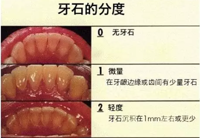 牙周炎，中國成年人后半生永遠的 痛 ！