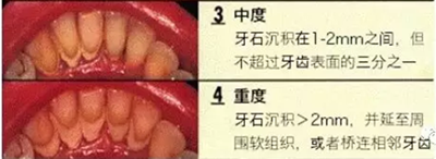 牙周炎，中國成年人后半生永遠的 痛 ！