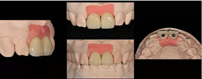 Asc全瓷角度基臺(tái)一體冠進(jìn)行種植前牙美學(xué)修復(fù)一例