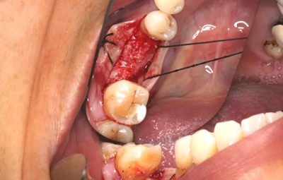 病例分享|下頜后牙牙槽嵴保存延期種植頰側(cè)骨壁吸收植骨引導(dǎo)骨再生一例